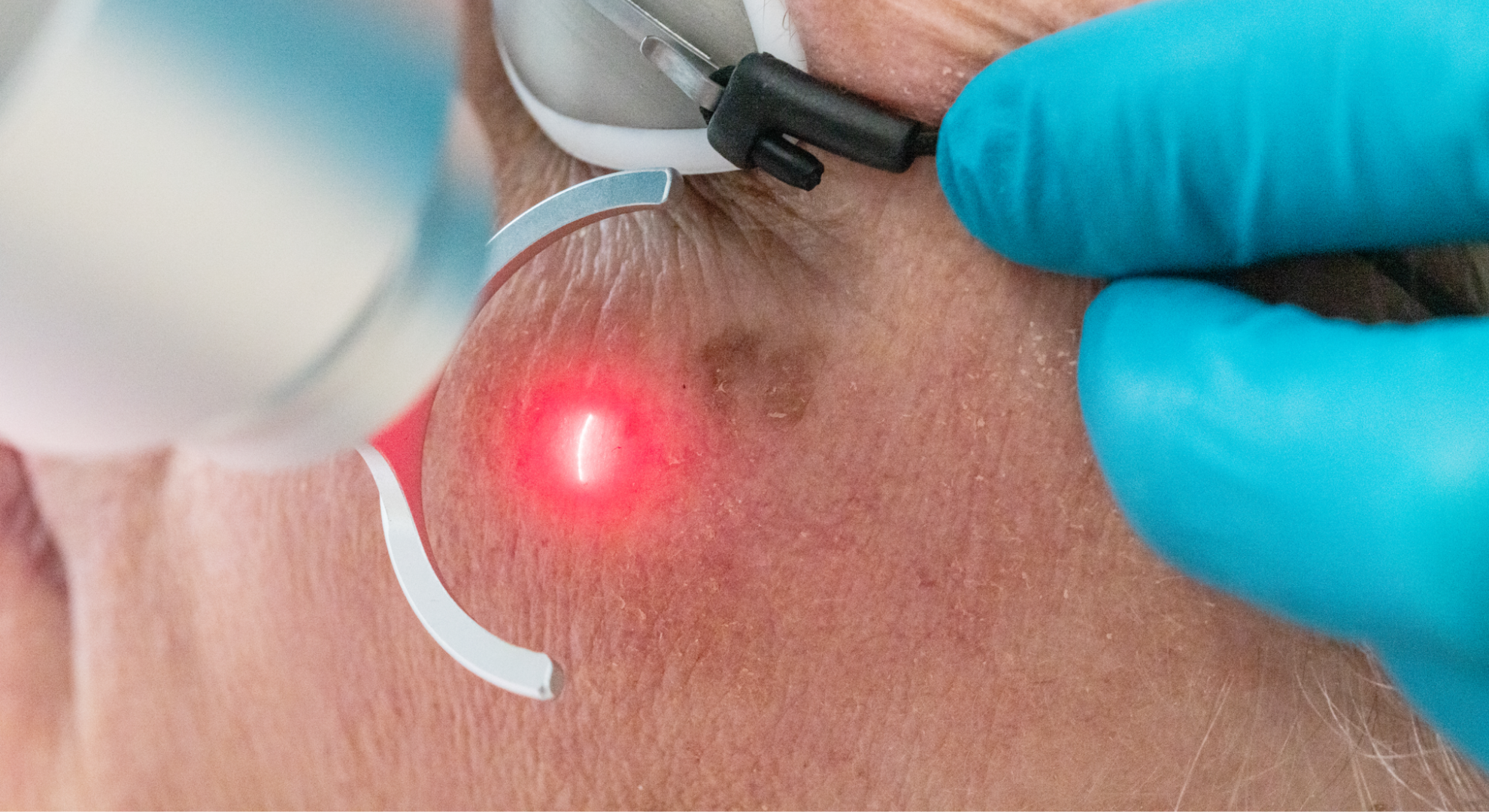 L wie Laser: Die CO2-Laserbehandlung – Ihr Schlüssel zur Hautverjüngung in Leipzig