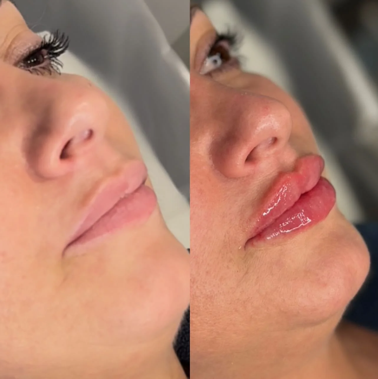 🔥 Lip Transformation! 🔥

I know posting a classic before-and-after feels a little dated these days&hellip; but when the results look THIS insane, how could I not?! 😍

💋 Russian-inspired technique for that lifted, defined, ultra-juicy look &mdash;