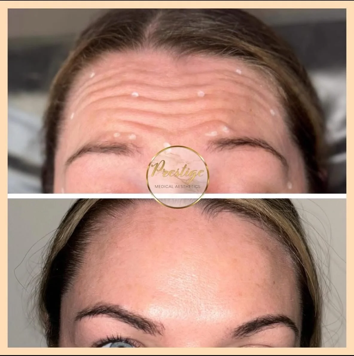 Last minute availability for our prescribing clinic tomorrow 12:30 - if you&rsquo;re wanting b-tox in the next 6 months you must see our prescriber face to face first. 

Treat yourself this payday week. 

Message to book 🫶🏻