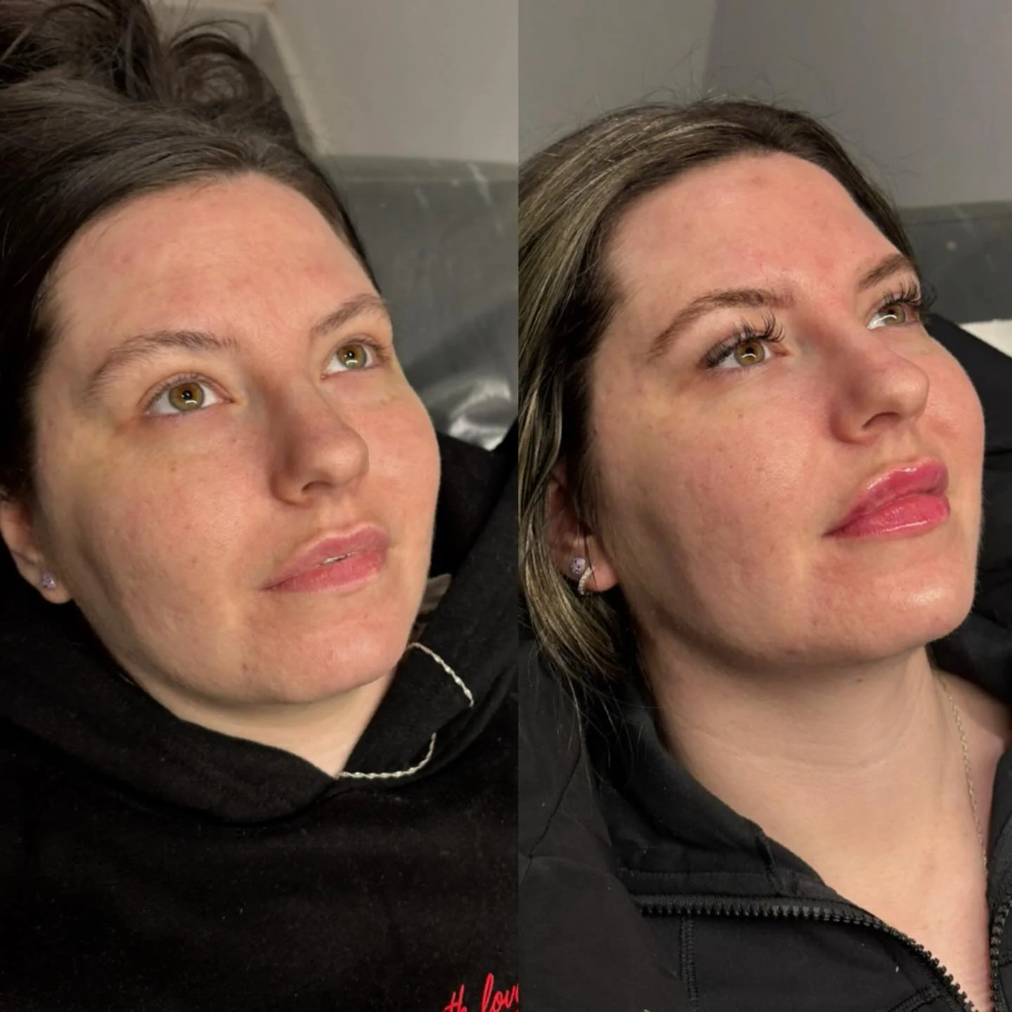 I don&rsquo;t usually post many before and afters these days&hellip; but when the results are this good, how could I resist? ✨

My client came to me feeling frustrated with a lack of definition and structure in her face. 
Together, we created a bespo