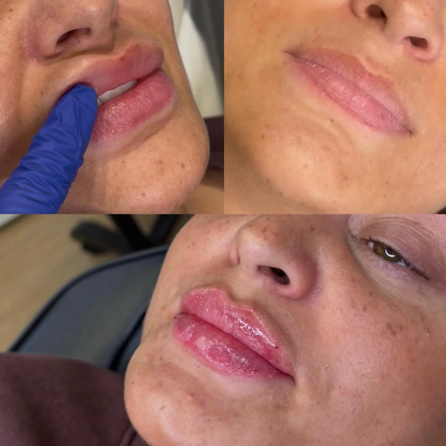 From dissolve to defined 💉✨

My client came to me after years of having her lips filled elsewhere, ready to start fresh. We made the decision to fully dissolve and rebuild &mdash; the right way.

Over the past 9 months, we&rsquo;ve taken a slow, str