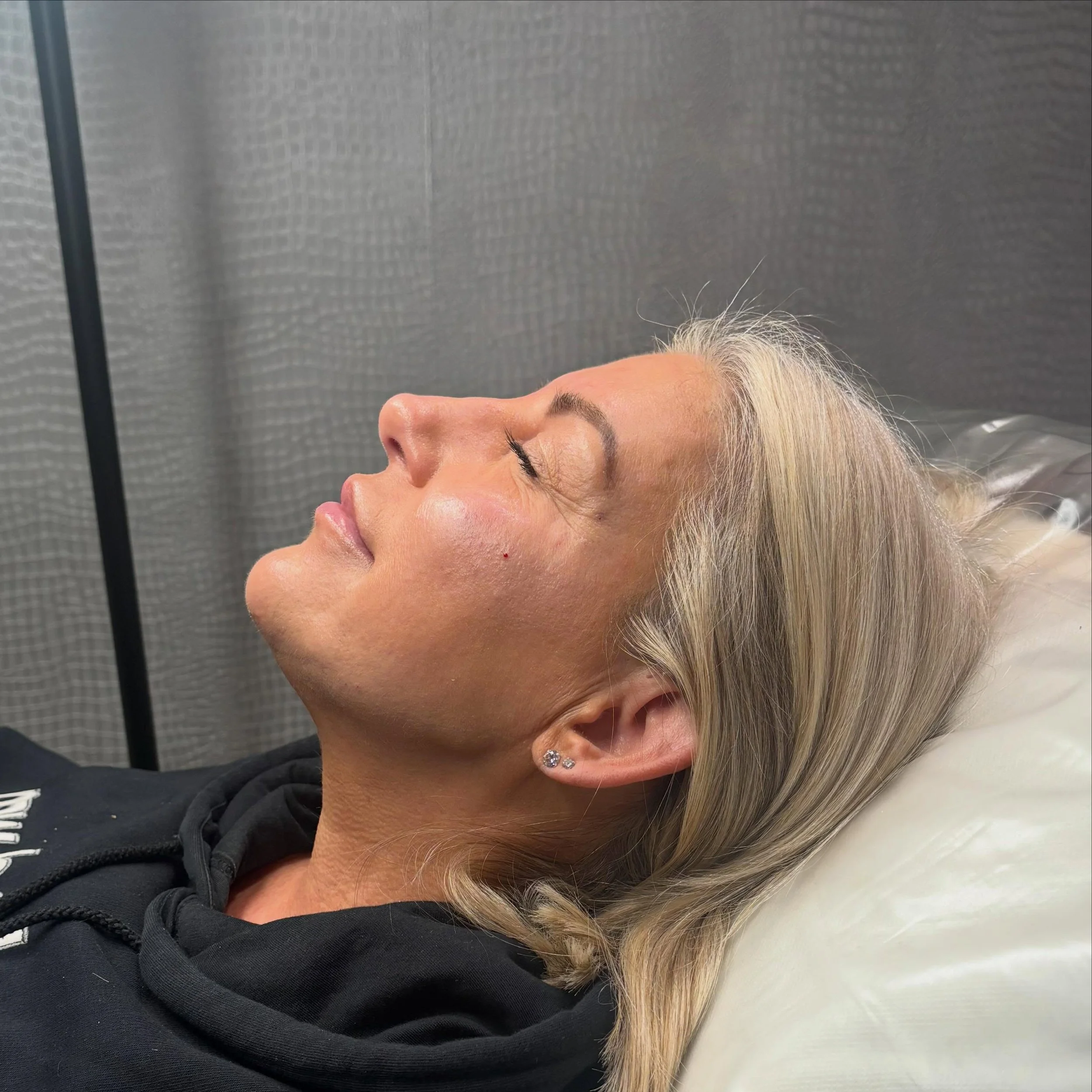 Results of our contour package - profile balancing whilst remaining natural. 

What&rsquo;s holding you back? 

DM to book your consultation now 🫶🏻