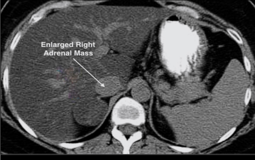 An image of an enlarged right adrenal mass.