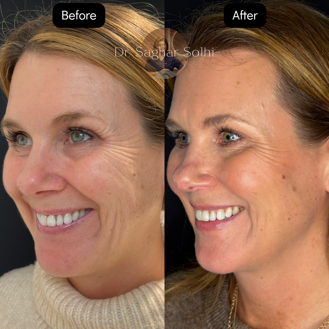 Före och efter behandling med Sunekos runt ögonen. Resultatet visar slätare hud, minskade fina linjer och återfuktad lyster.