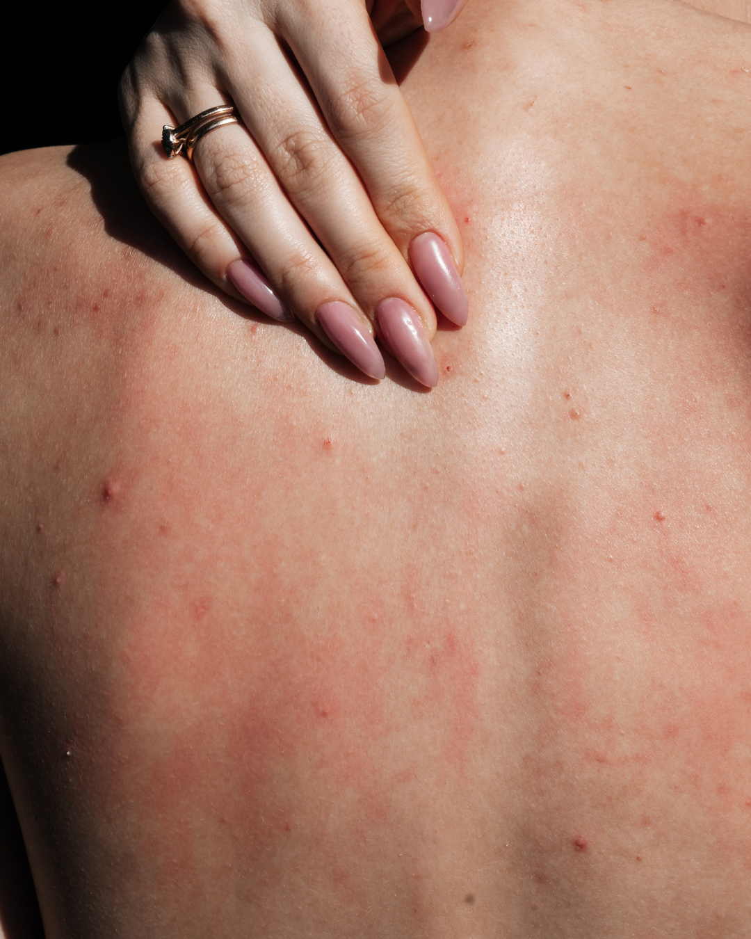 Breaking Out After the Gym? Here’s What’s Actually Causing It