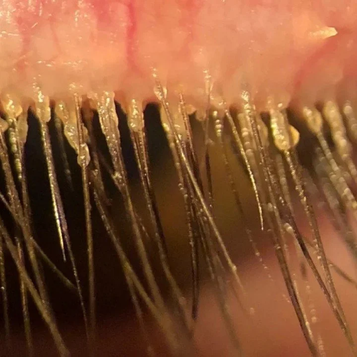 Imagine the microscopic mites that live on your skin, making a home in your eyelash follicles... We have drops for that!! 

Come SEE us! 815-216-4600.

It's more common then we'd like to think and can lead to itching, redness and recurrent styes--but