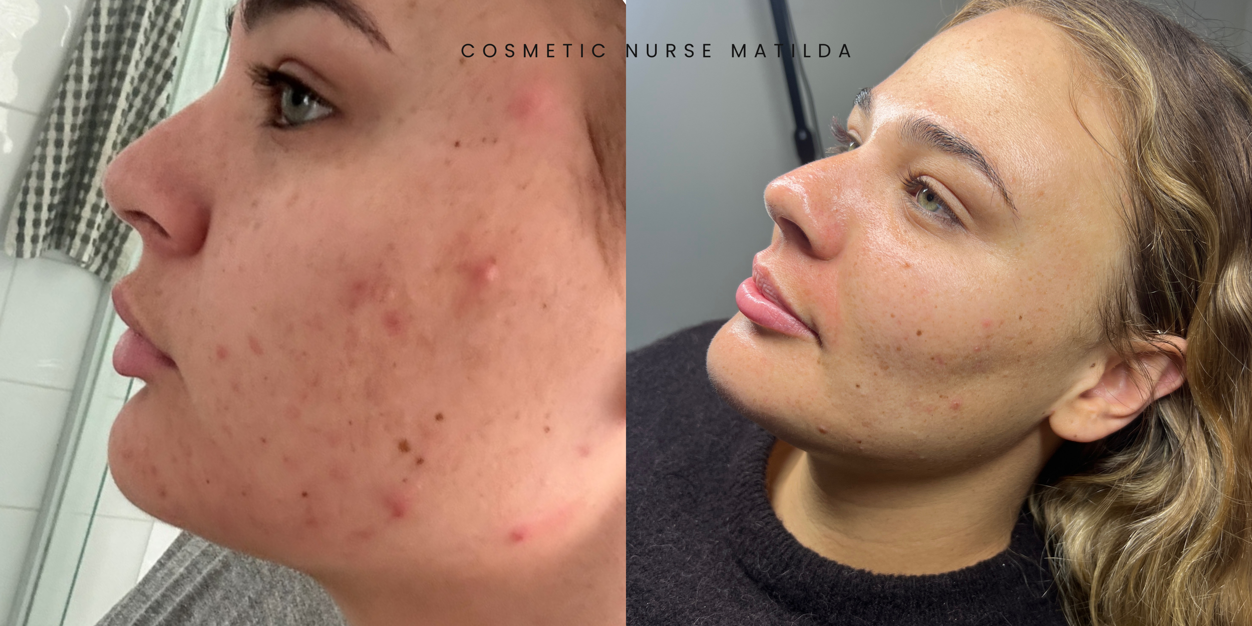 Side by side comparison of a woman's face before and after skincare treatment, showing reduced acne and clearer skin.