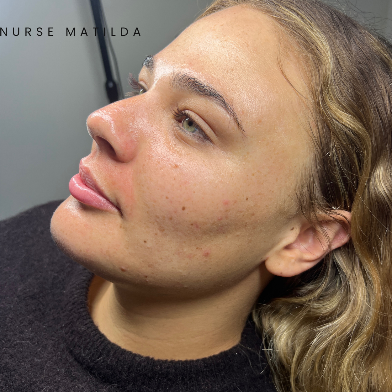 Close-up of a woman with light skin and wavy blonde hair, showing her face with acne and redness, lying on her side in a clinical setting. Text in the image reads 'NURSE MATILDA'.