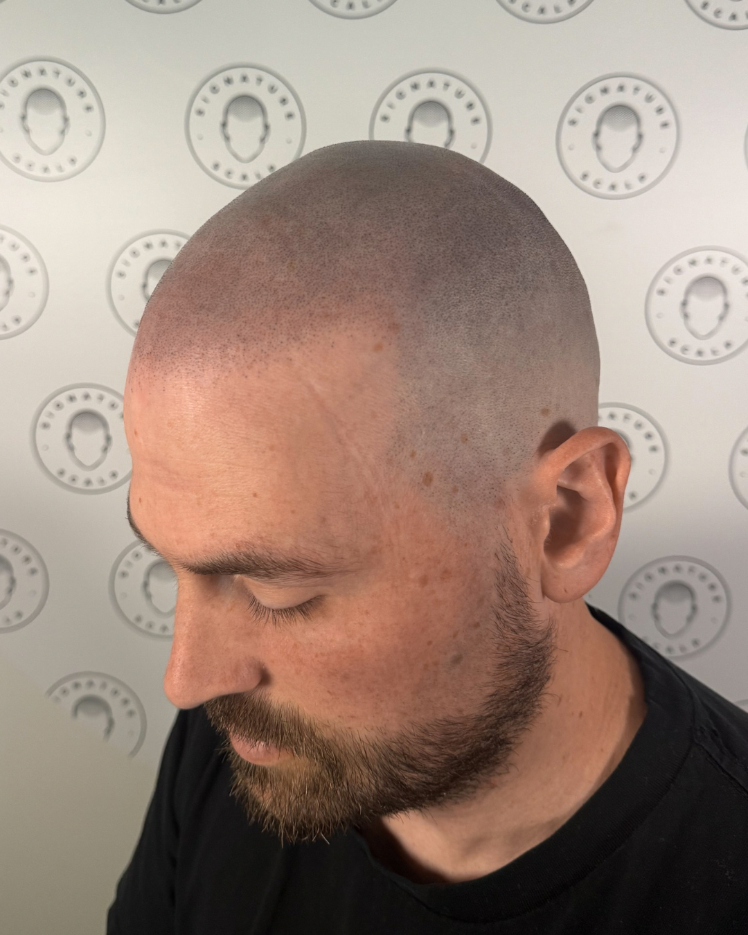 A fresh result of a male client from Signature Scalp. 