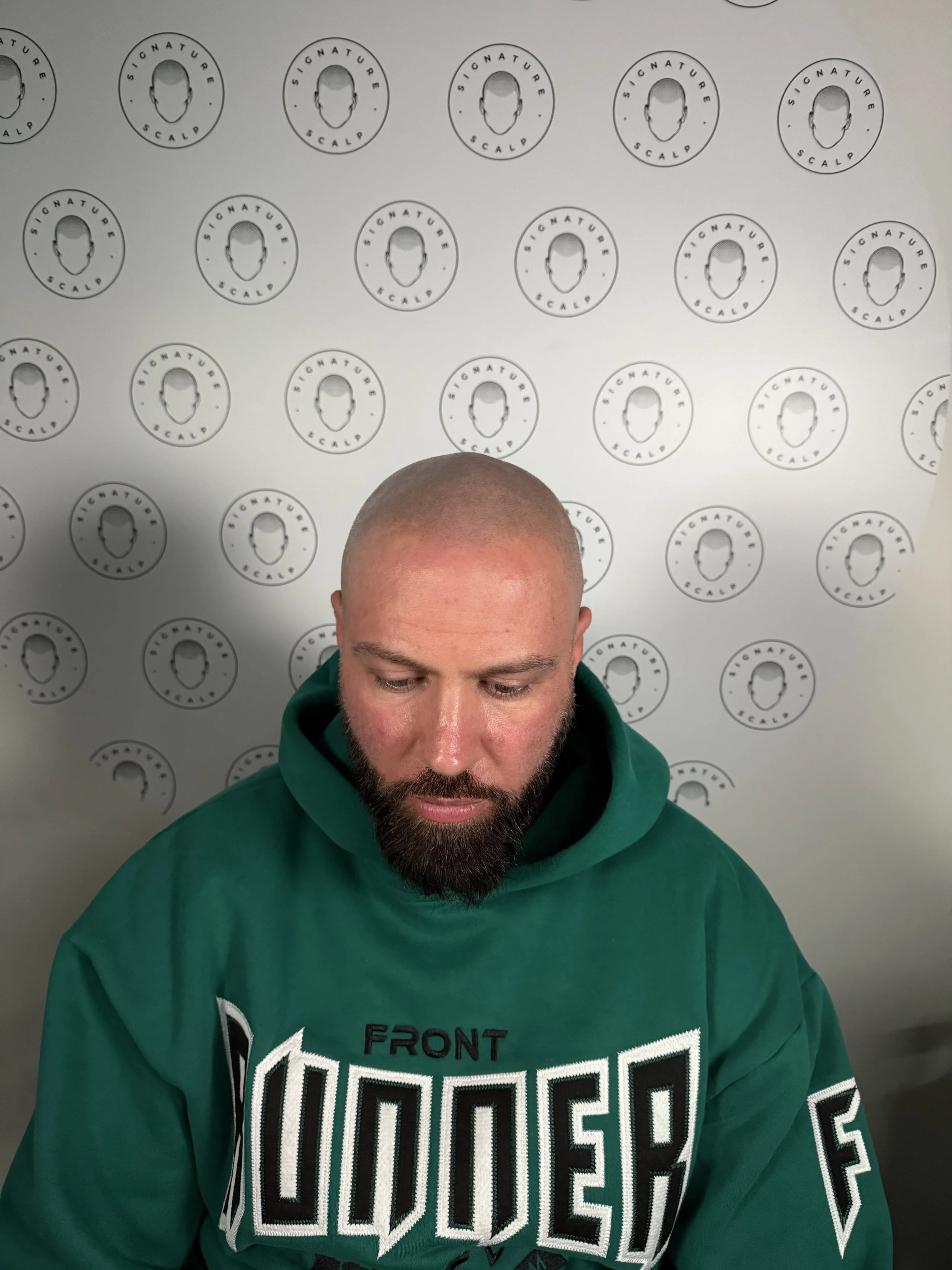 A front view of completed Scalp Micro-Pigmentation redarkening