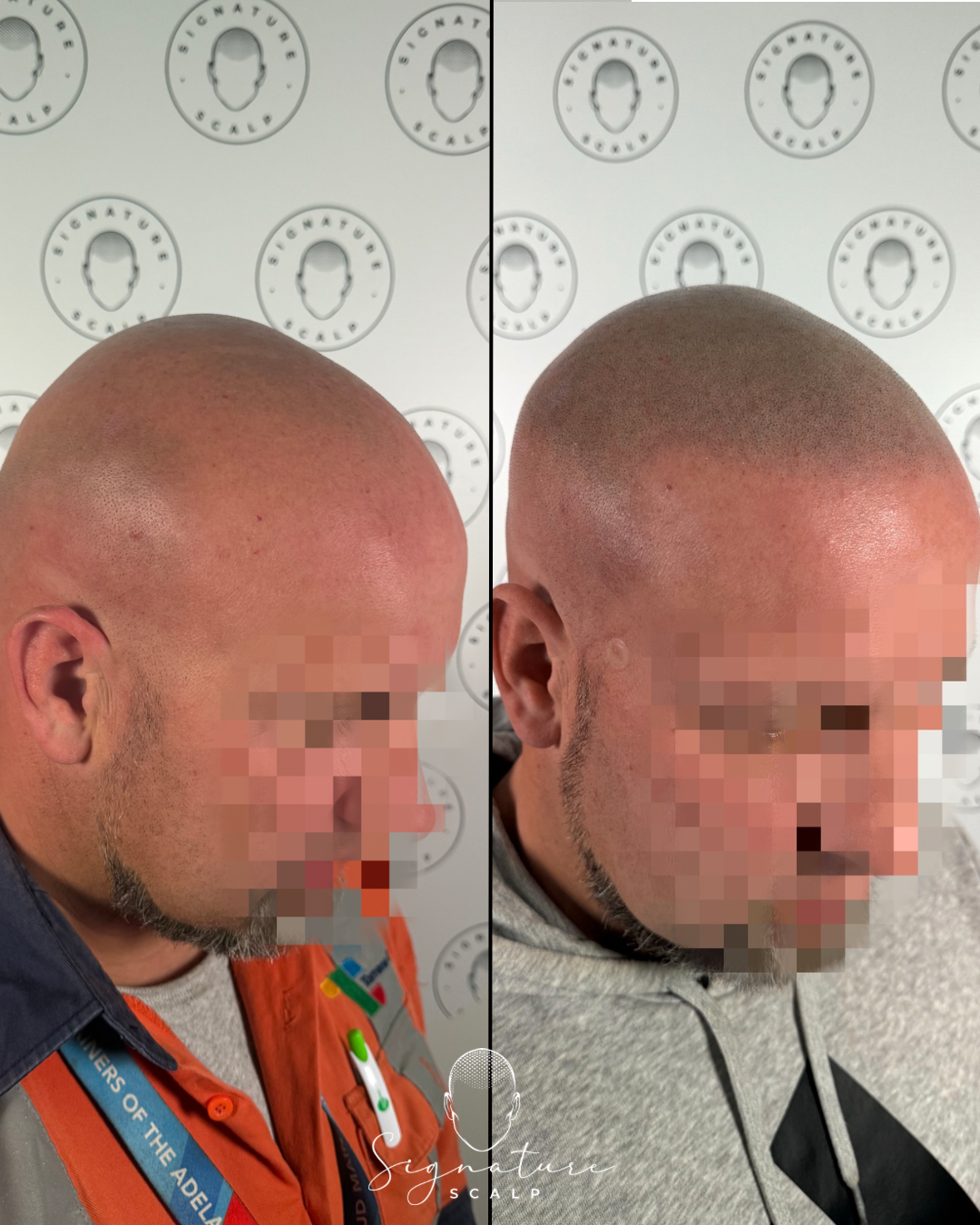 SMP for a Receding Hairline