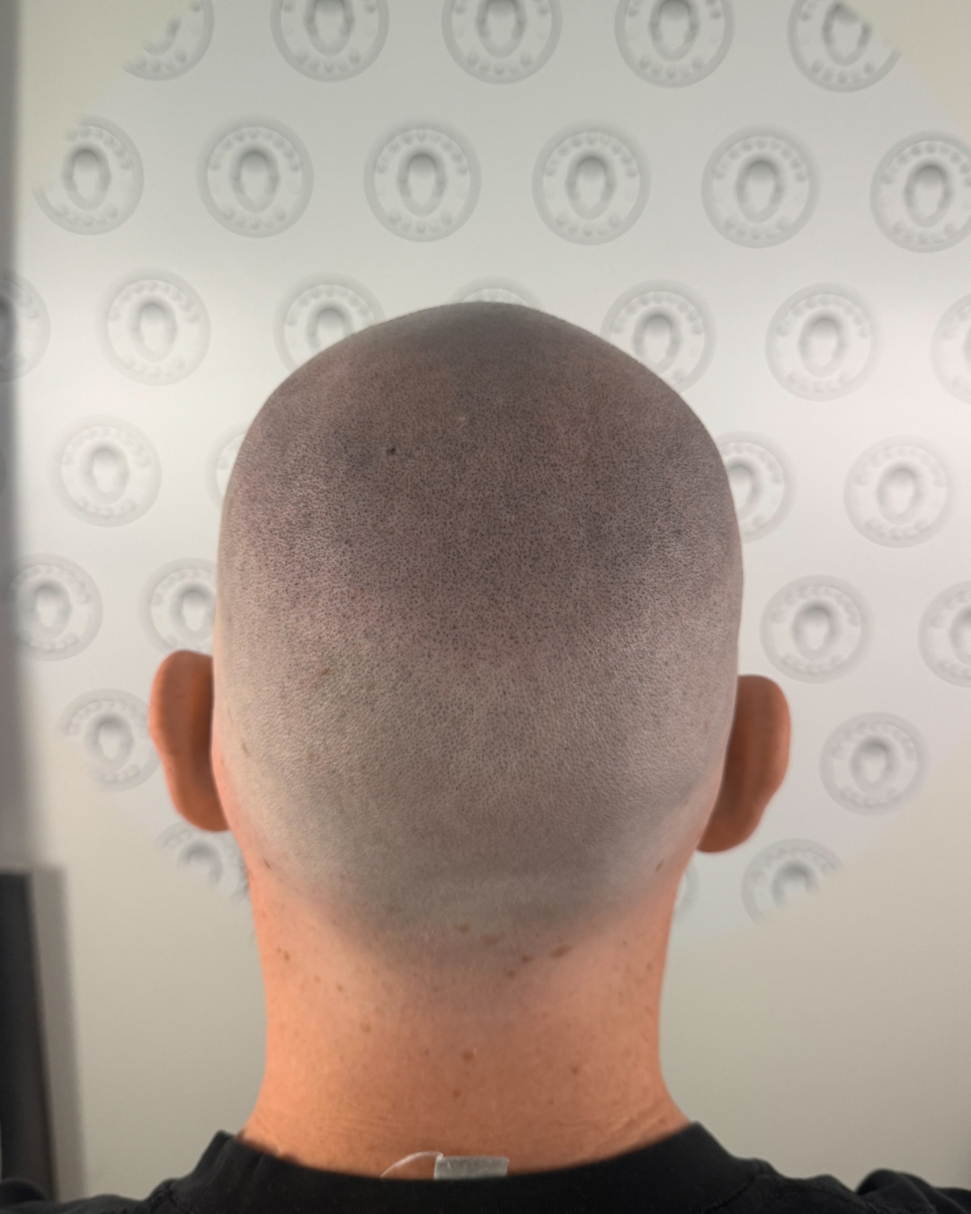 A fresh result of a male client from Signature Scalp.