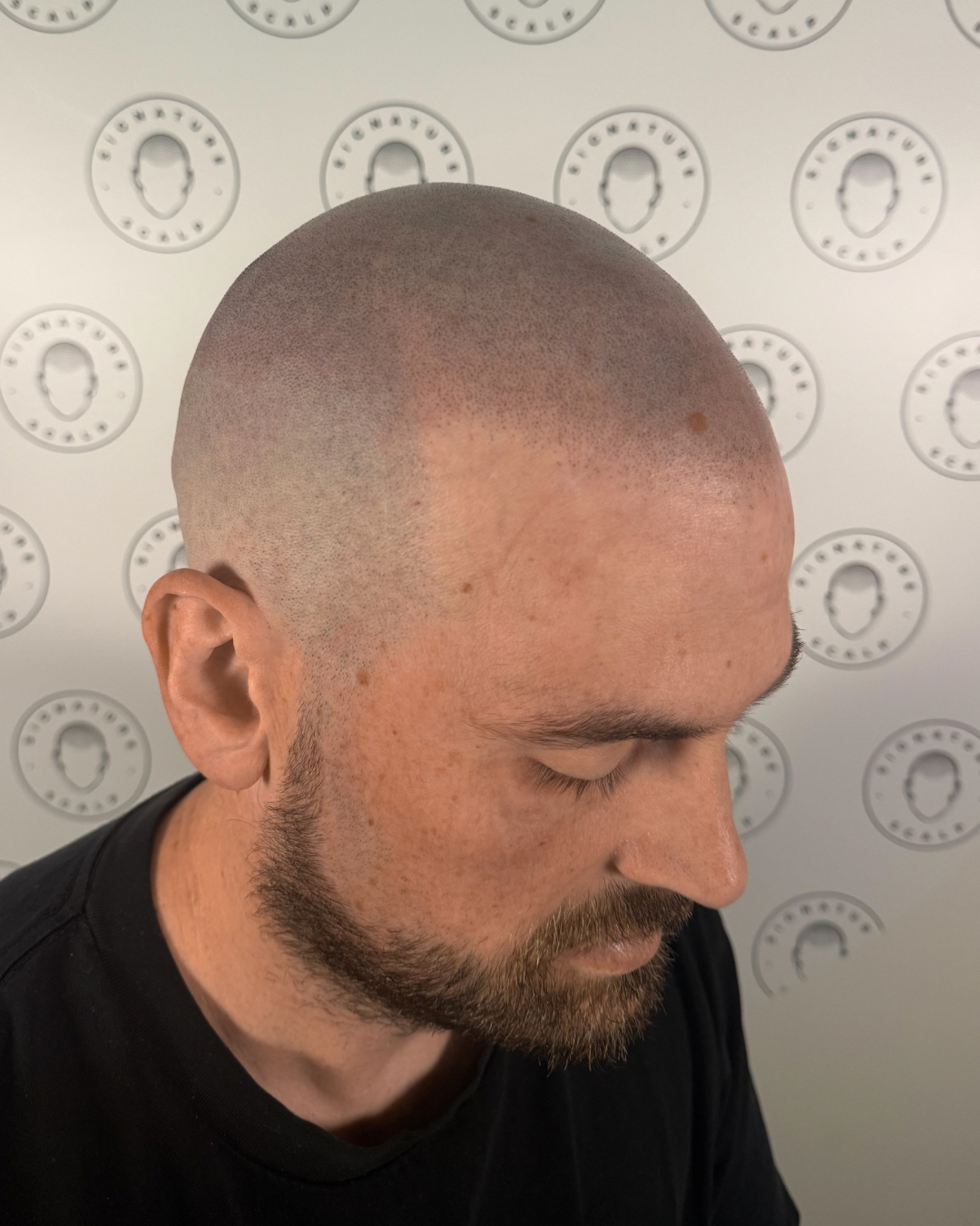 A fresh result of a male client from Signature Scalp.