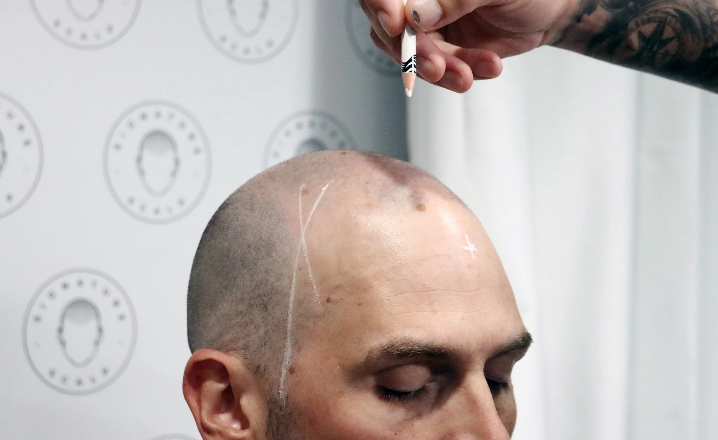 Signature Scalp Adelaide SMP artist working on male client during scalp micropigmentation session
