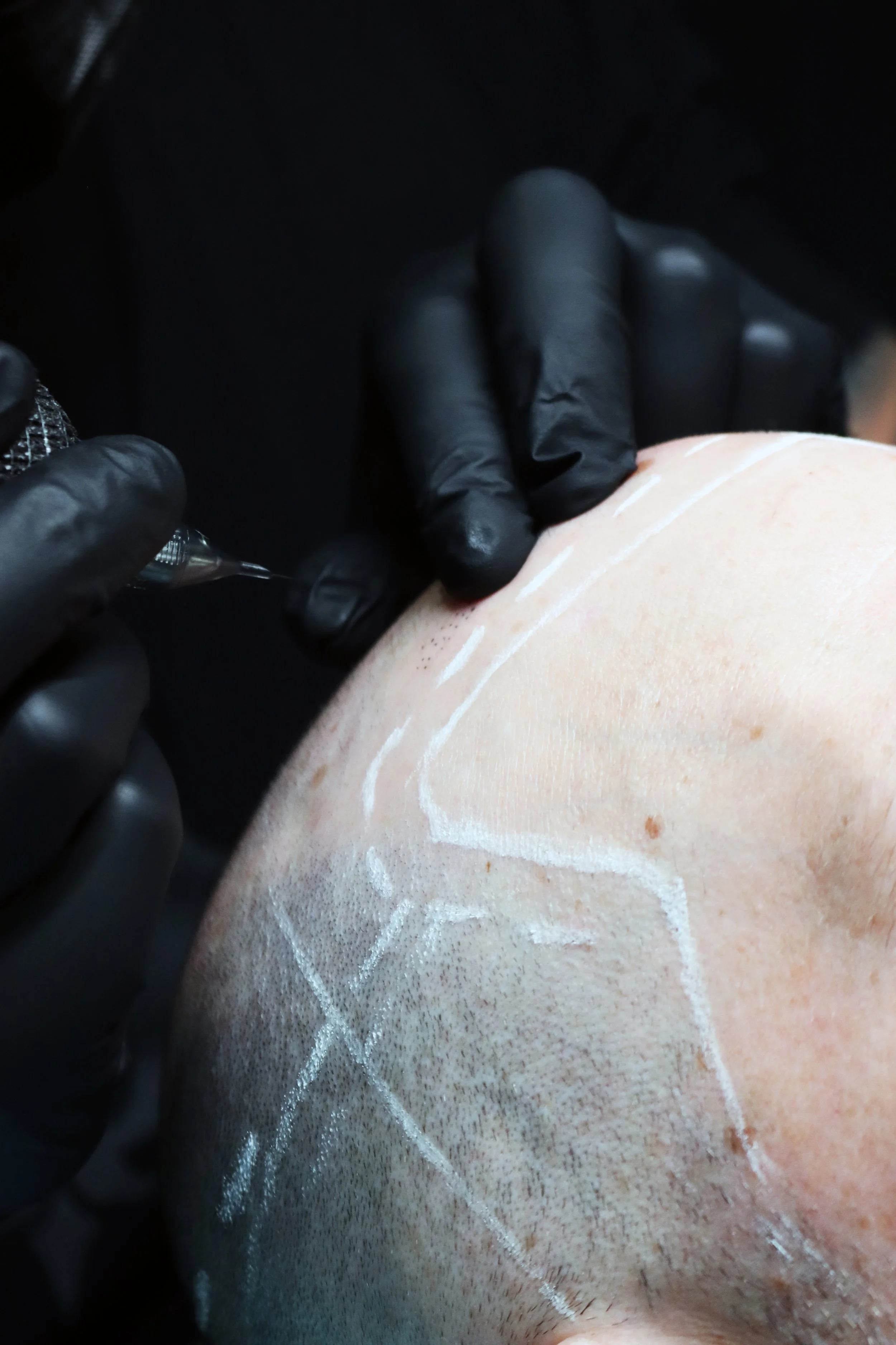 Does Scalp Micropigmentation Hurt?