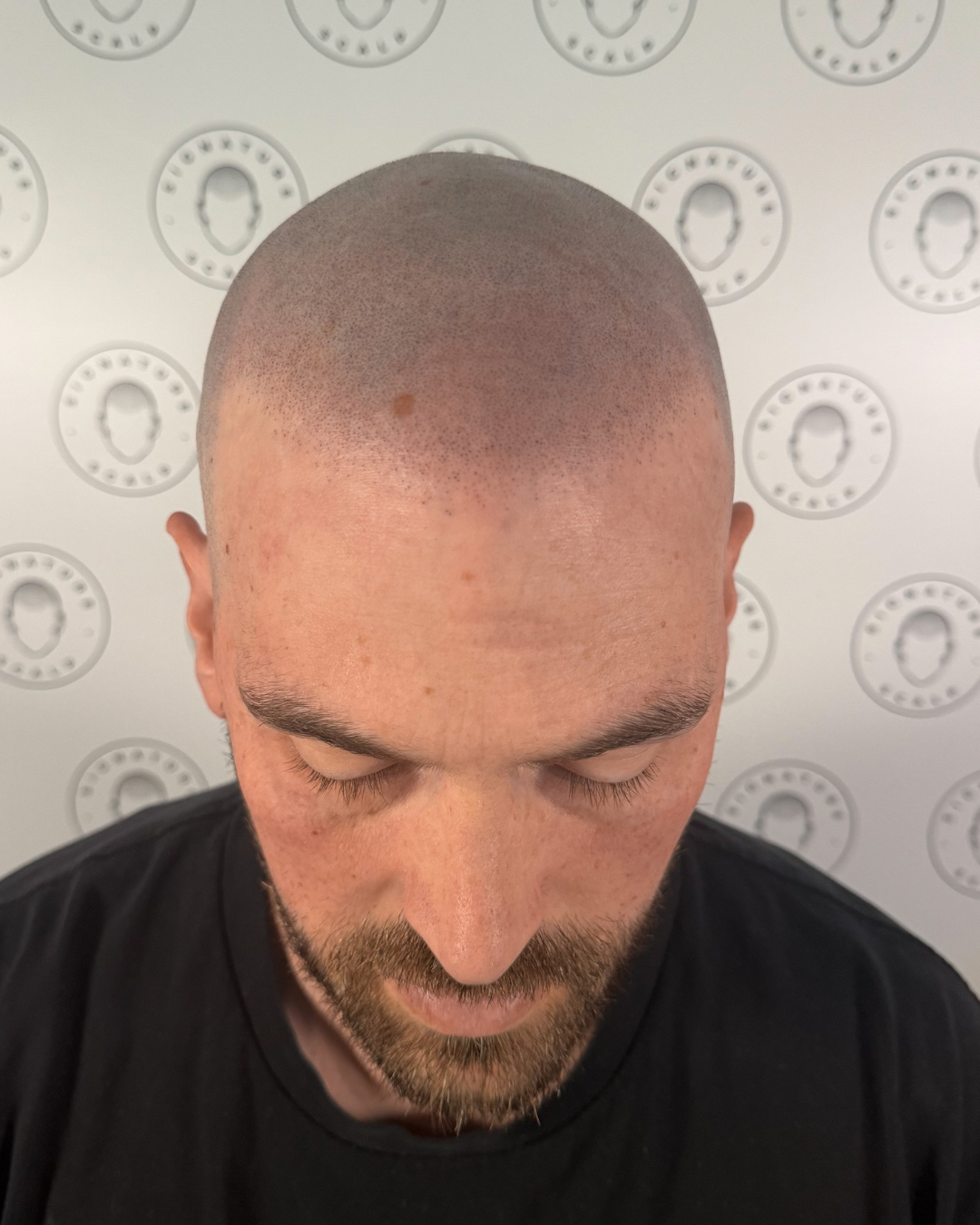 A fresh result of a male client from Signature Scalp.