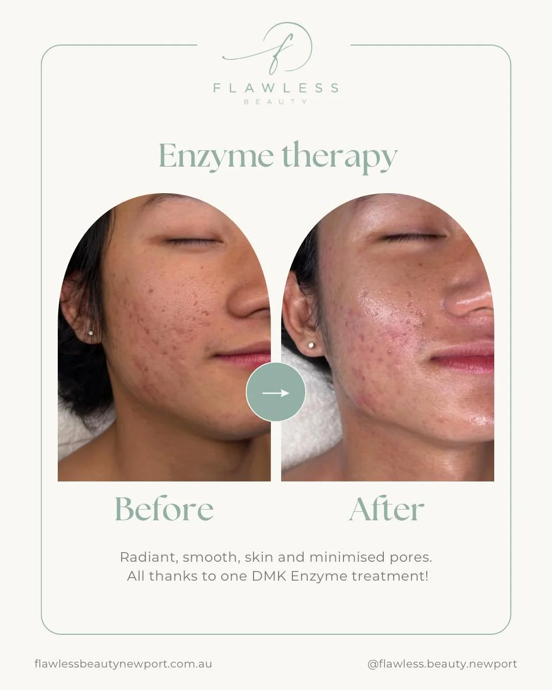 Those First DMK Enzyme Feels ✨
Noticeably more hydrated skin &amp; smoother texture - no filters, just real results. 
This isn&rsquo;t your average facial - it&rsquo;s skin revision at its finest.
Because your skin deserves real results, not just pro