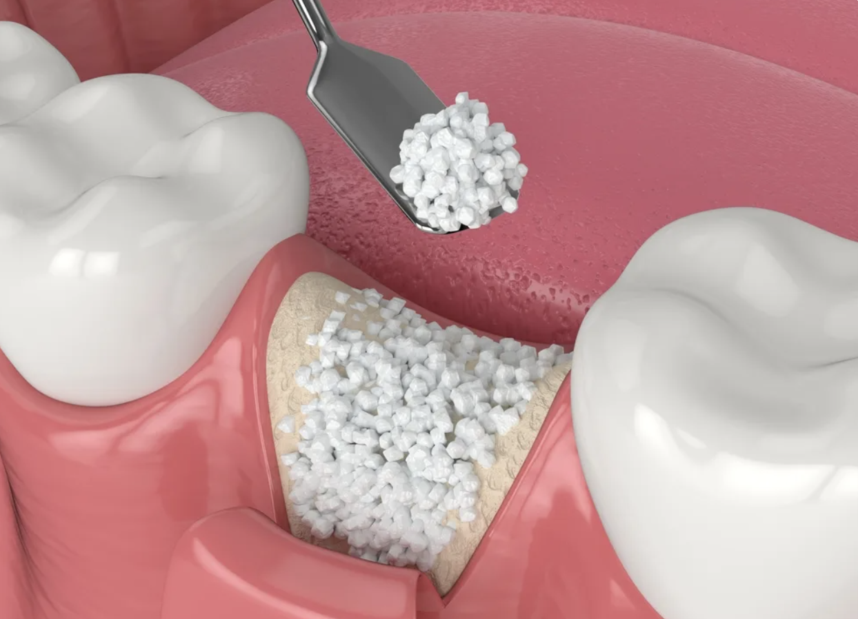A dental procedure using cavity fill material with a dental mirror, surrounded by healthy teeth and gums.