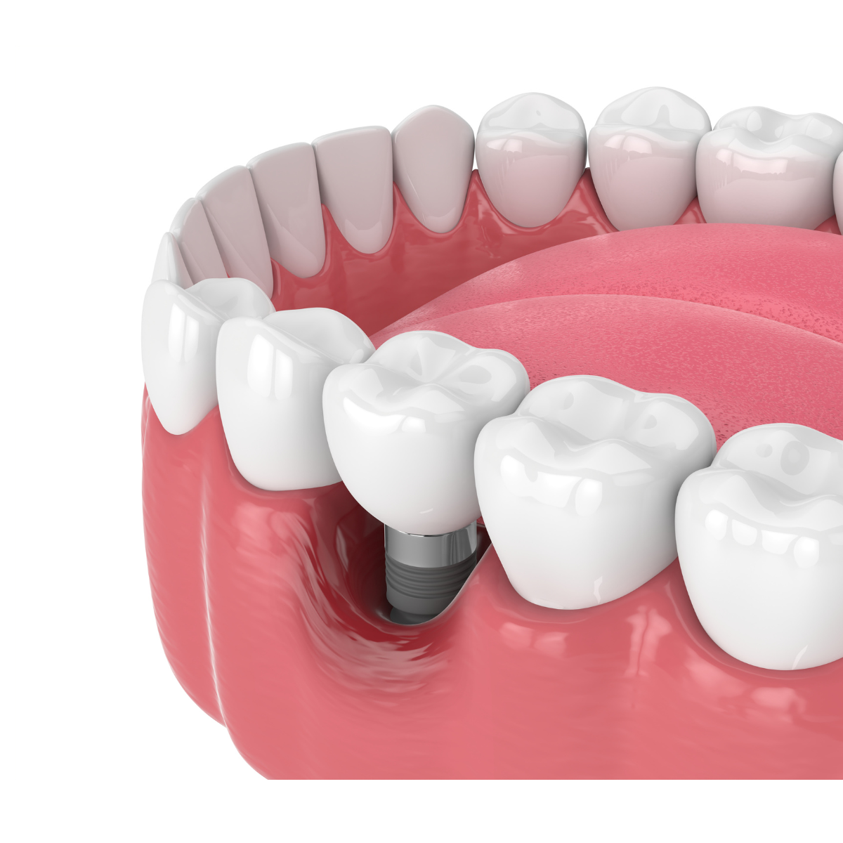 Illustration d'une dent avec implant dentaire visible dans la mâchoire inférieure.