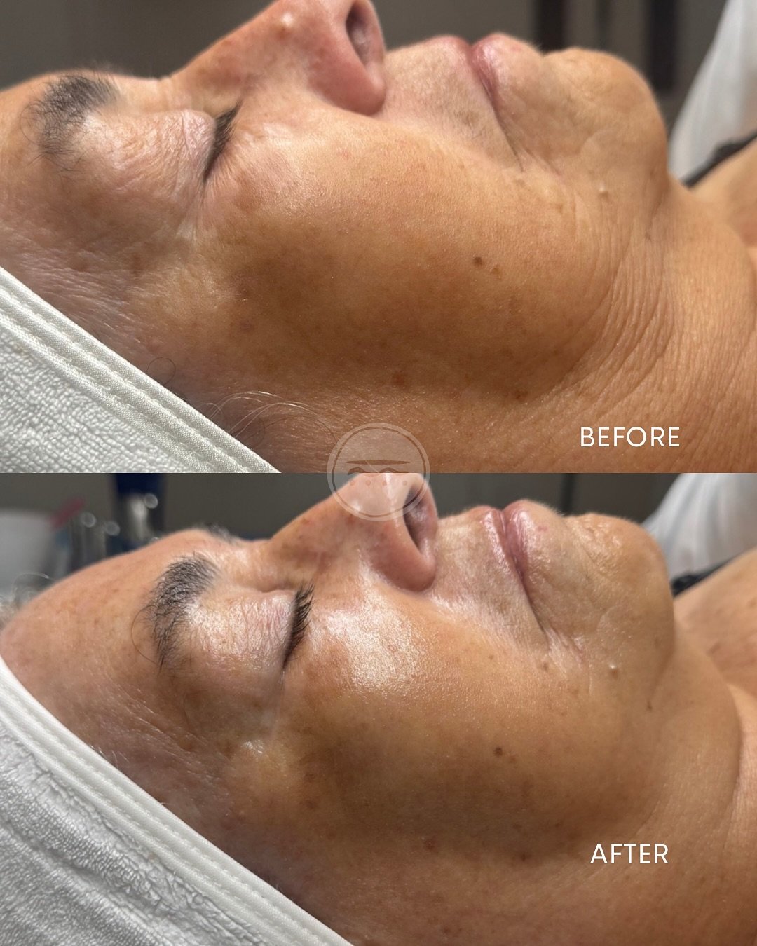 Neveskin facials are one of my favorite treatments at Boketto. Designed to lift, tone, and rejuvenate the skin using a combination of thermal shock technology and cryotherapy. This dynamic contrast stimulates collagen production, improves circulation