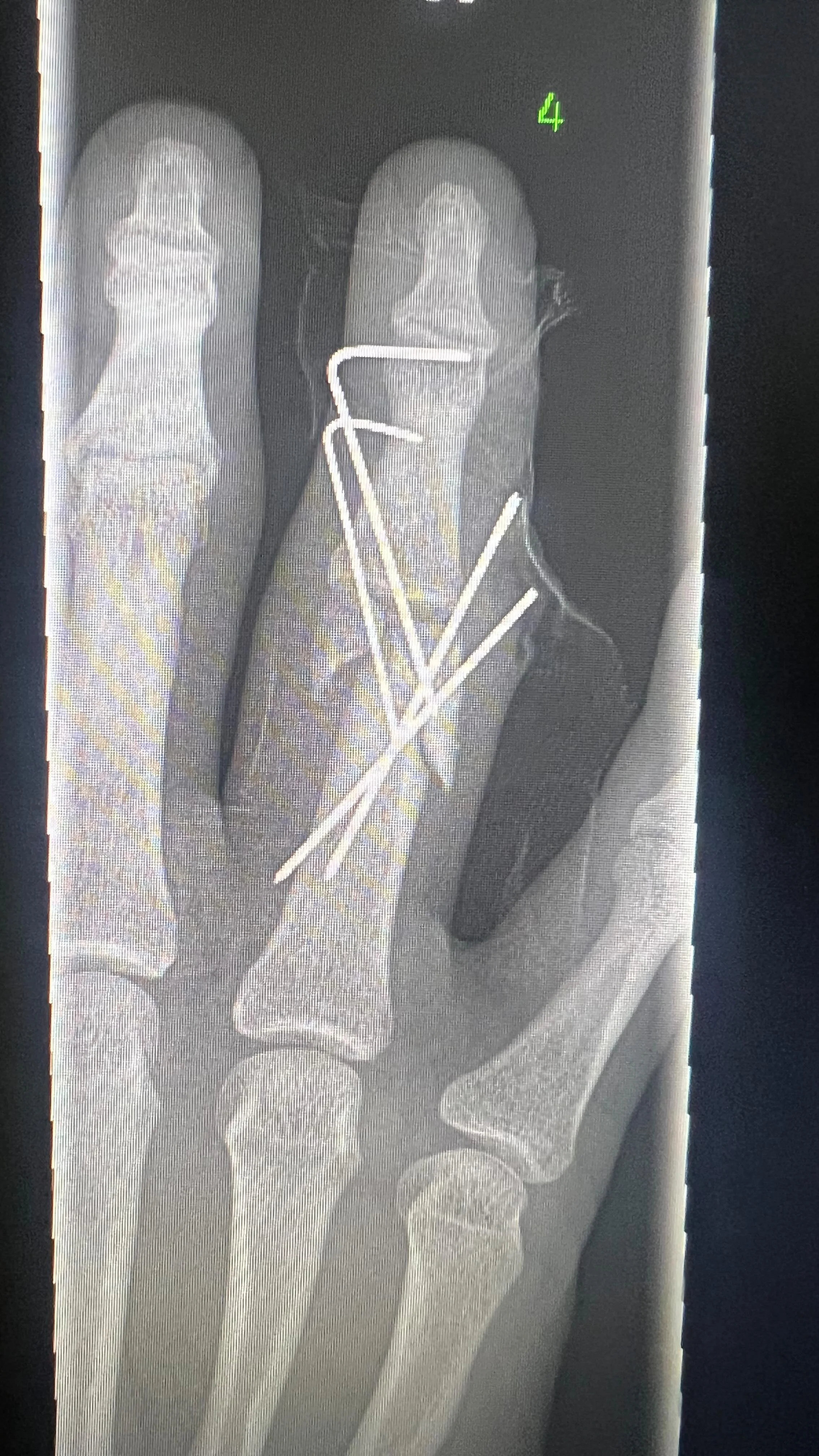 12 weeks since finger surgery. My training looks a bit different these days but it feels so good to be able to move again.