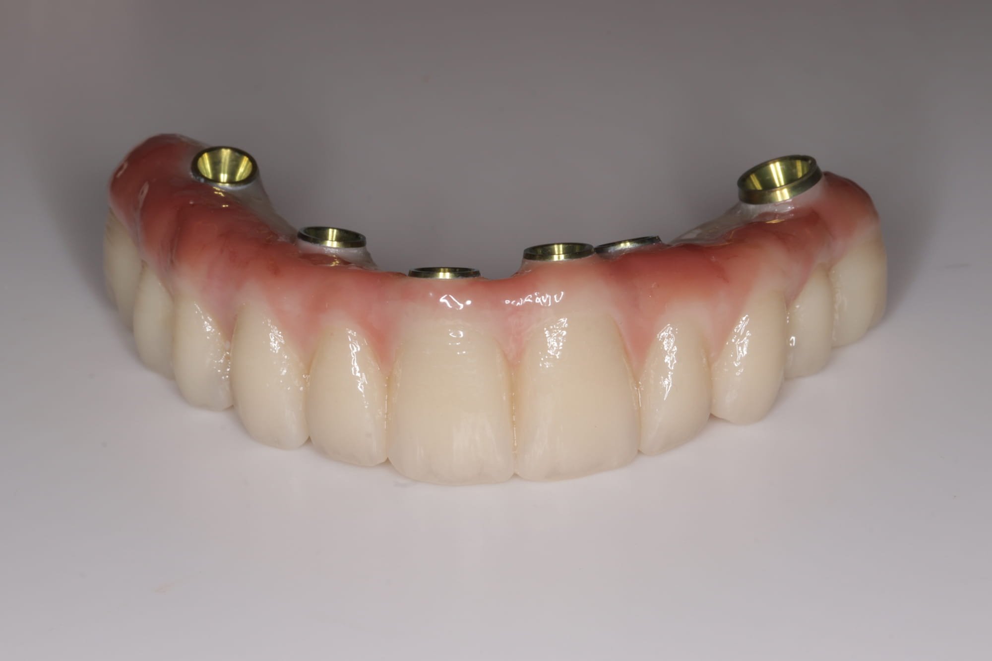 All-on-4 dental implant bridge restoration – Chapter One Dental Edinburgh