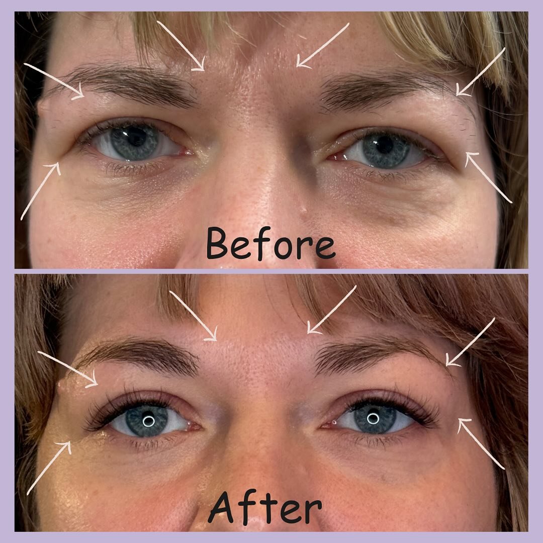 A before and after picture of a client whose main concern was to treat some of the hooding around her eyes. There is alot happening here - so let&rsquo;s dive in 

Treating areas of concern is so important. Especially if it&rsquo;s specific. In order