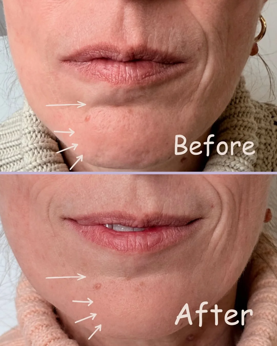 Lower face Botox is all about the subtle shift. 

It&rsquo;s not about changing your face, it&rsquo;s about softening tension, creating balance and allowing the natural contours of your face to lift. 

Sometimes the difference isn&rsquo;t something e