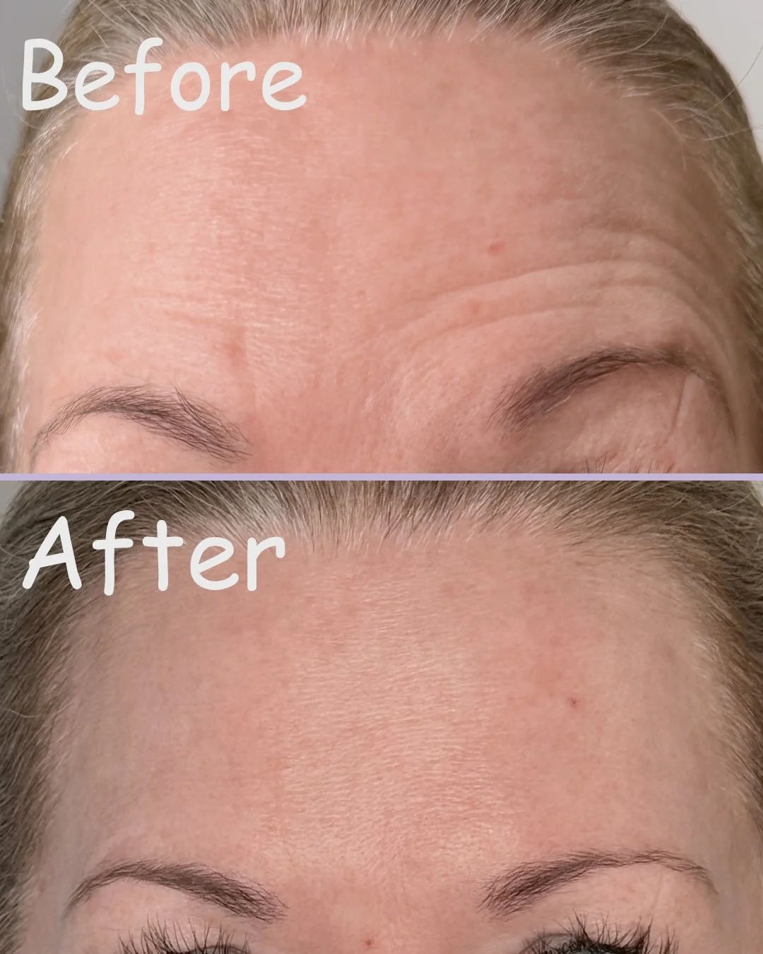 Not every forehead is the same. Not every injection pattern fits every forehead. Understanding anatomy and also performing a proper assessment is key to better results. 

We love a fresh looking forehead ✨

#dysport #cosmeticinjections #skin #beauty