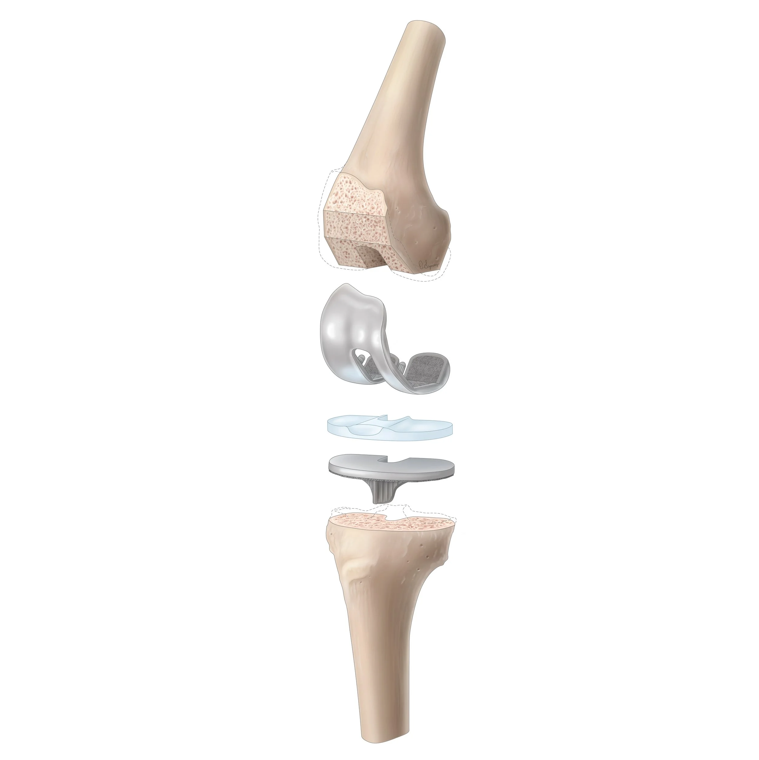 Exploded knee PROSTHETIC-01.jpg