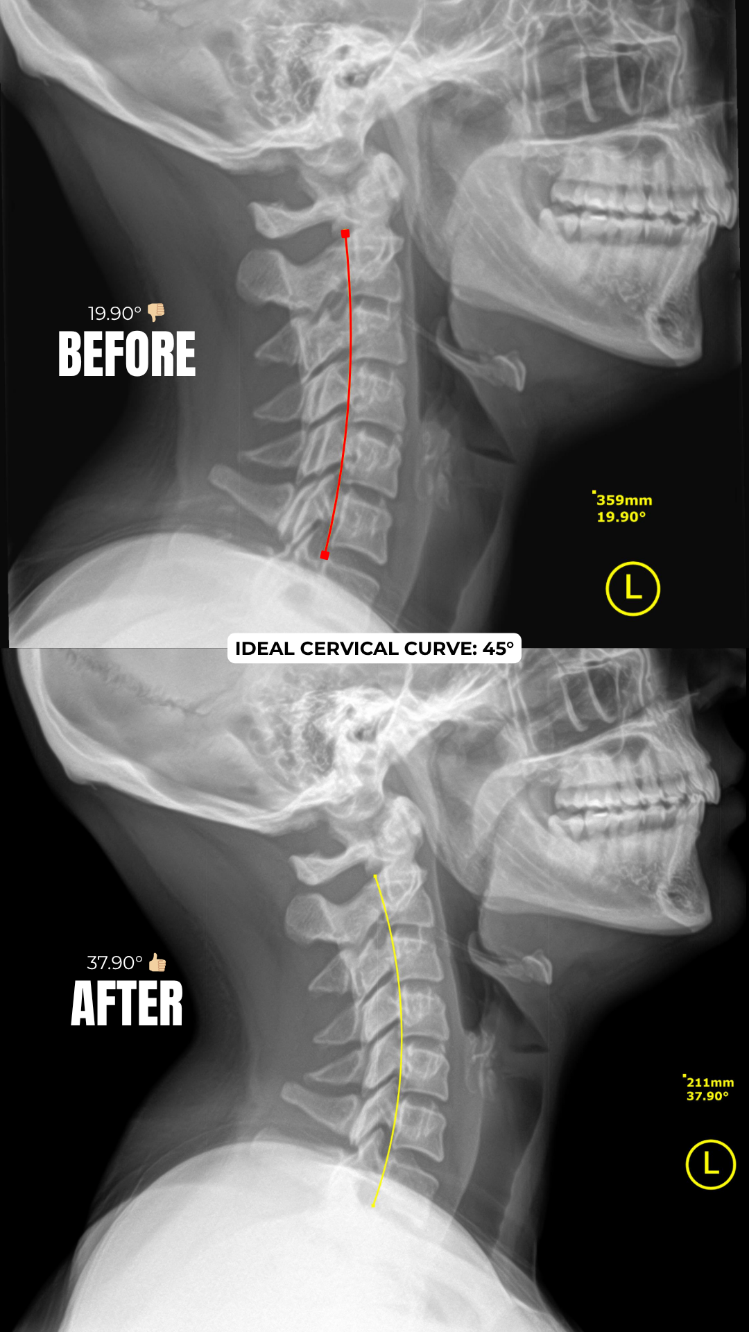 Cervical Curve Transformation