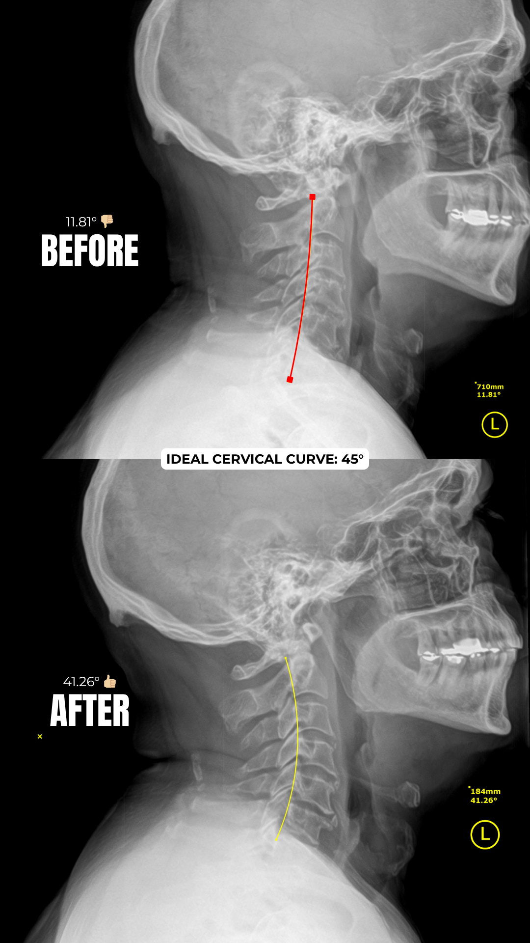 Cervical Curve Transformation