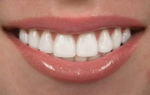 Dental Veneers: All your questions answered.