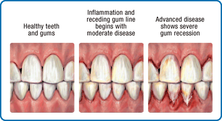 Why do my gums bleed?