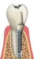 Is an Implant just like a real tooth?