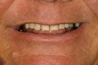 What is wrong with going overseas to have my implants placed cheaply?