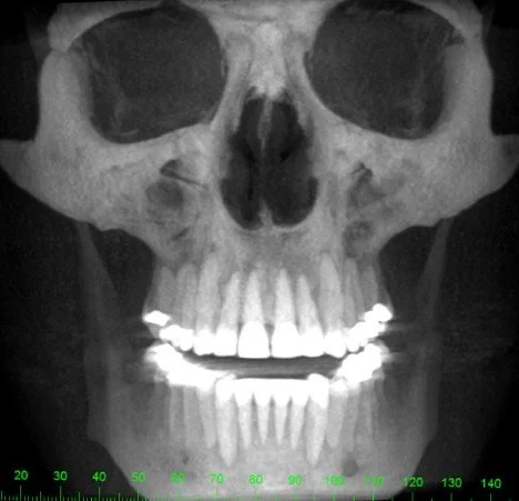 Can Implants help me?
