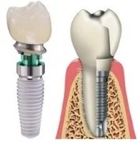 Implant Blog #1