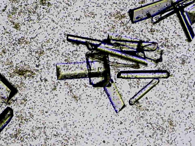 Bilden visar struvitkristaller och röda blodceller i urin hos en katt