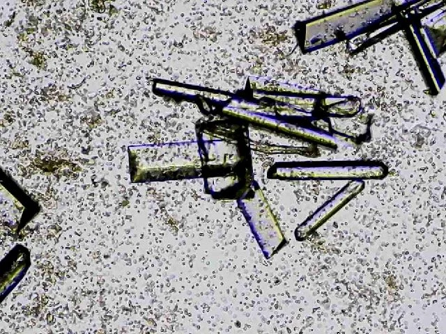 Bilden visar struvitkristaller och röda blodceller i urin