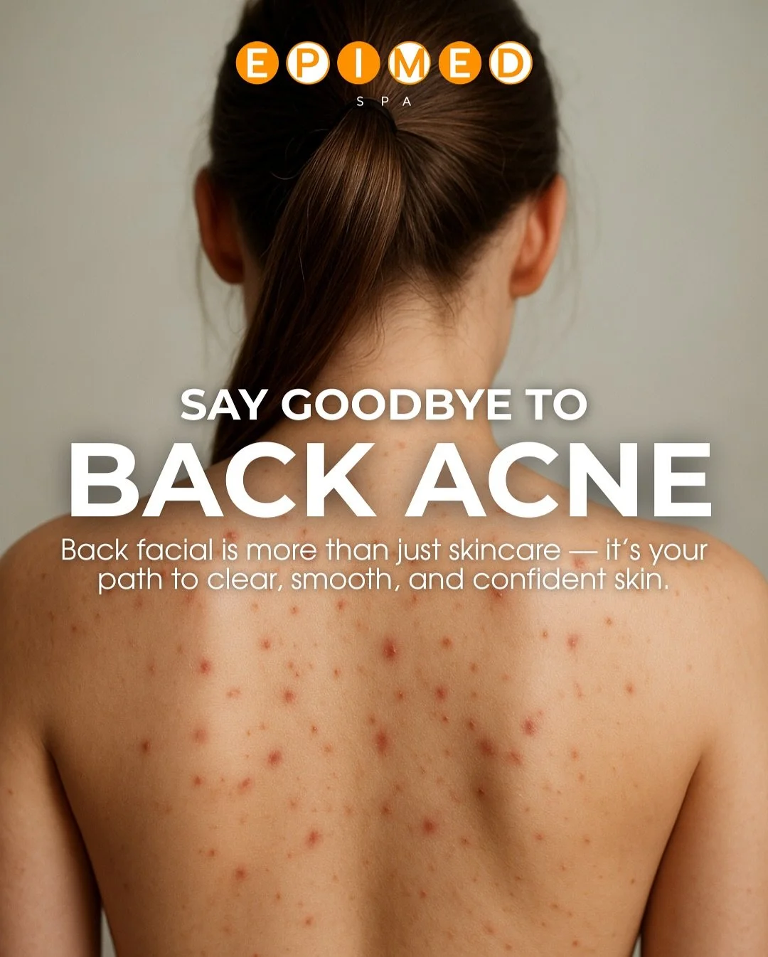 Back acne can be frustrating &mdash; but it doesn&rsquo;t have to be permanent. With the right treatment and simple lifestyle habits, your skin can look and feel amazing again.🧡

At Epimedspa, our customized back facials go beyond the surface: we cl