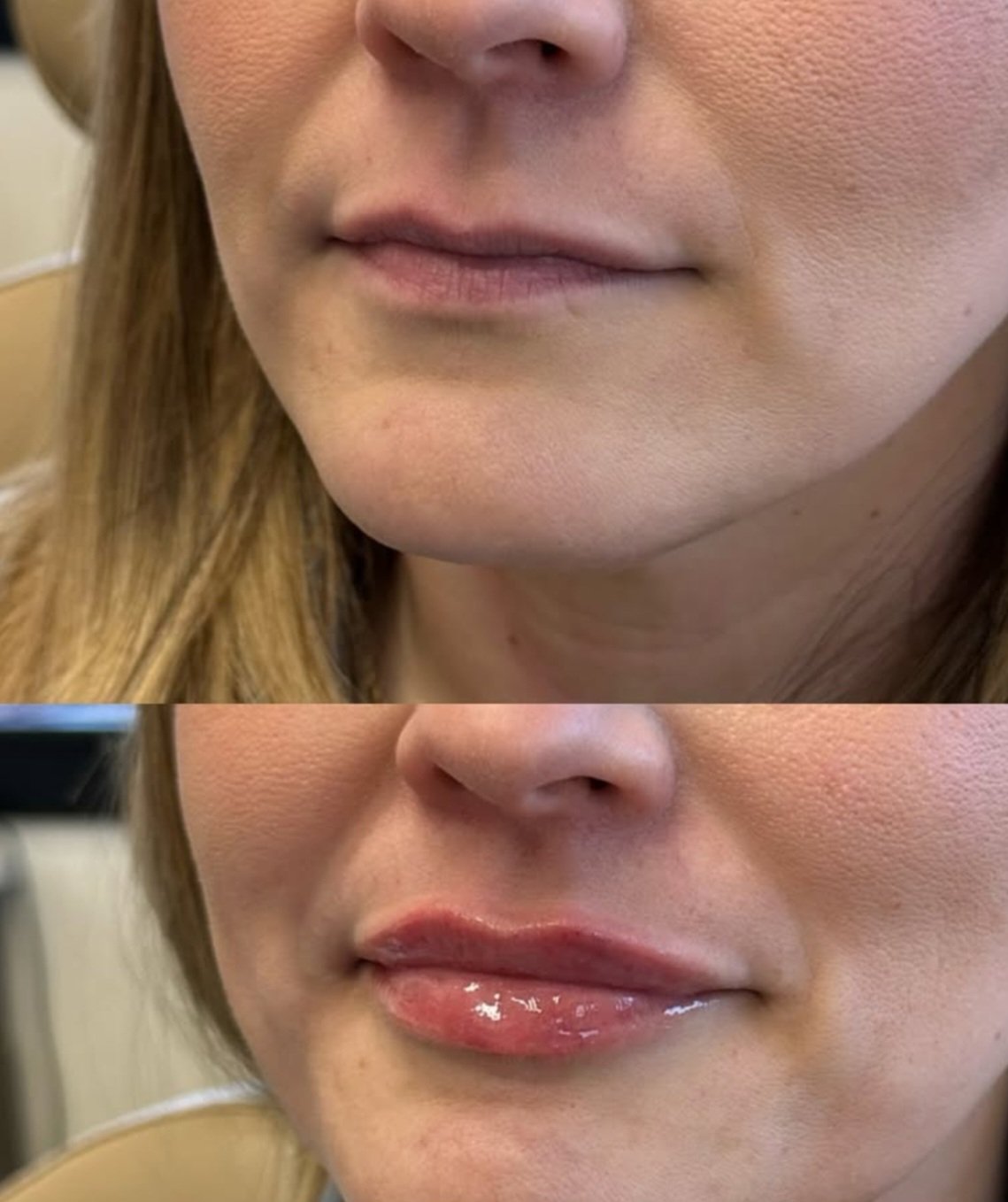 dermal fillers in Yorktown for lips and cheeks