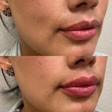 dermal fillers in Yorktown for lips and cheeks