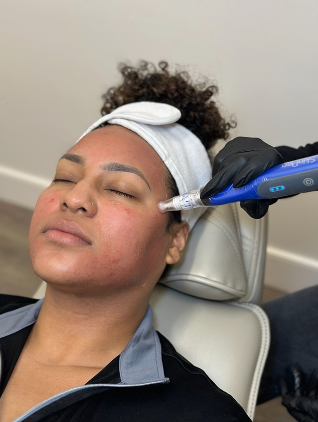 microdneedling in yorktown