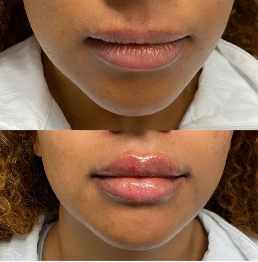 Before and after lip augmentation showing fuller lips