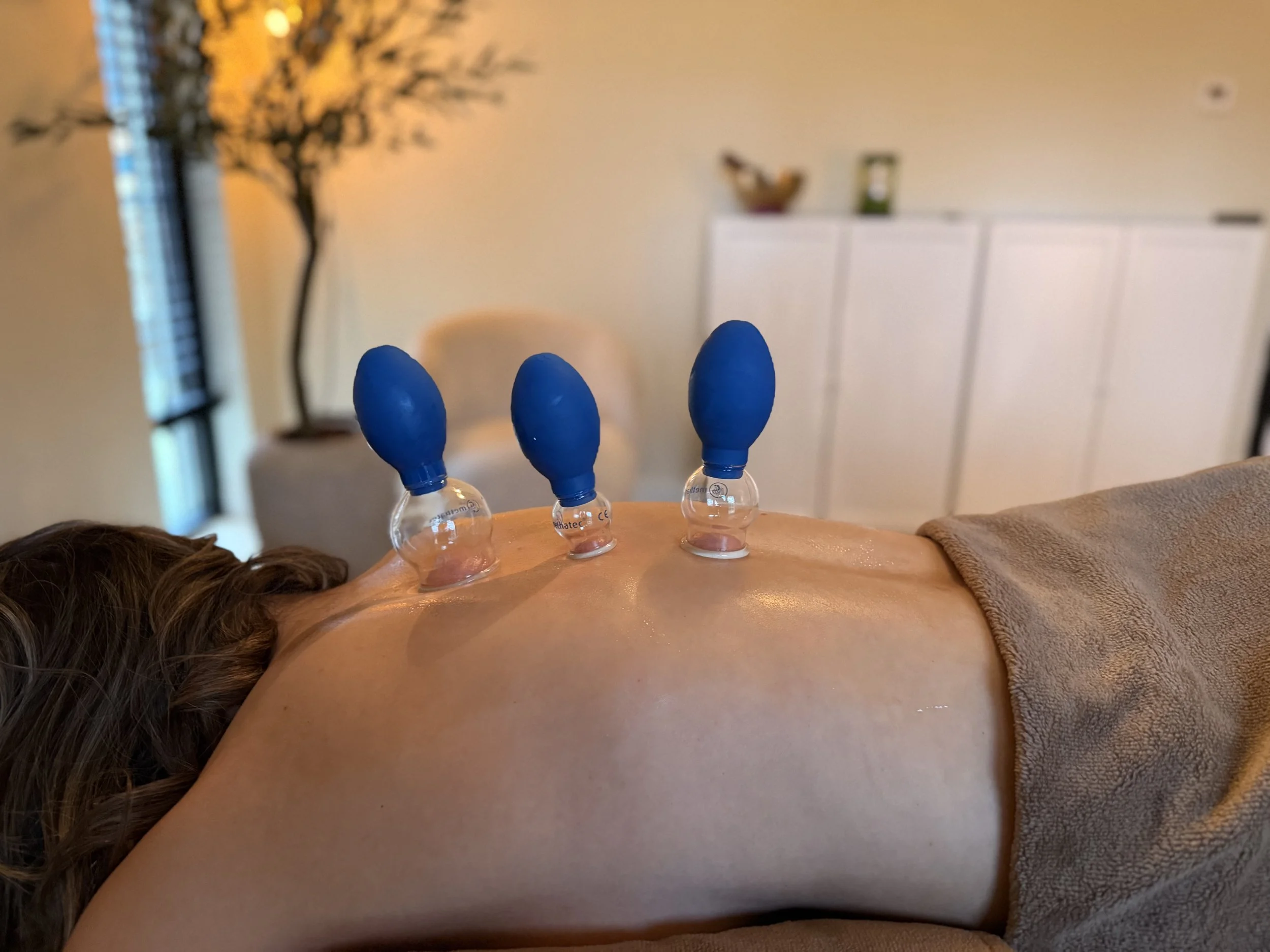 Persoon krijgt een acupunctuursessie met drie blauwe siliconen klysters op de rug, in een wellness- of behandelingsruimte.