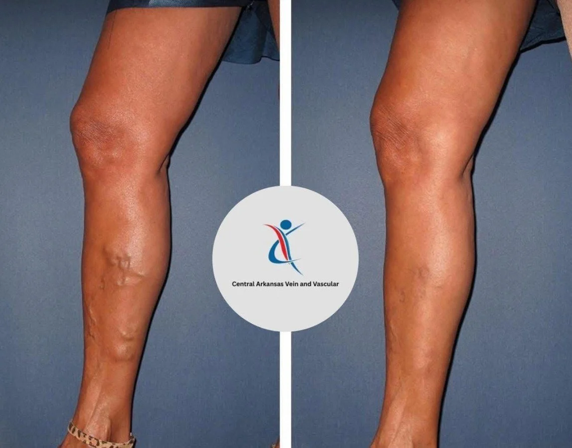 Comparison of legs showing varicose veins and their removal, with a logo for Central Arkansas Vein and Vascular in the center.