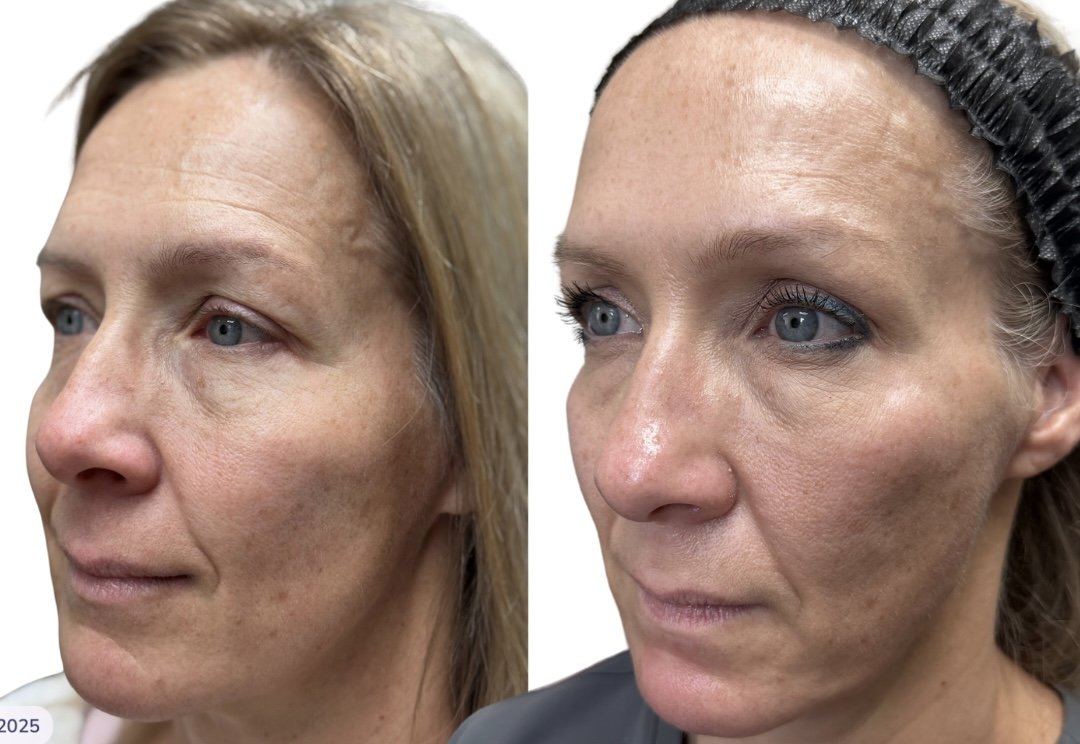 Cheek filler Jawline filler