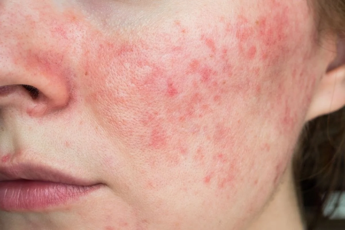 Rosacea Flare-Ups: How to Calm Redness and When to See a Dermatologist