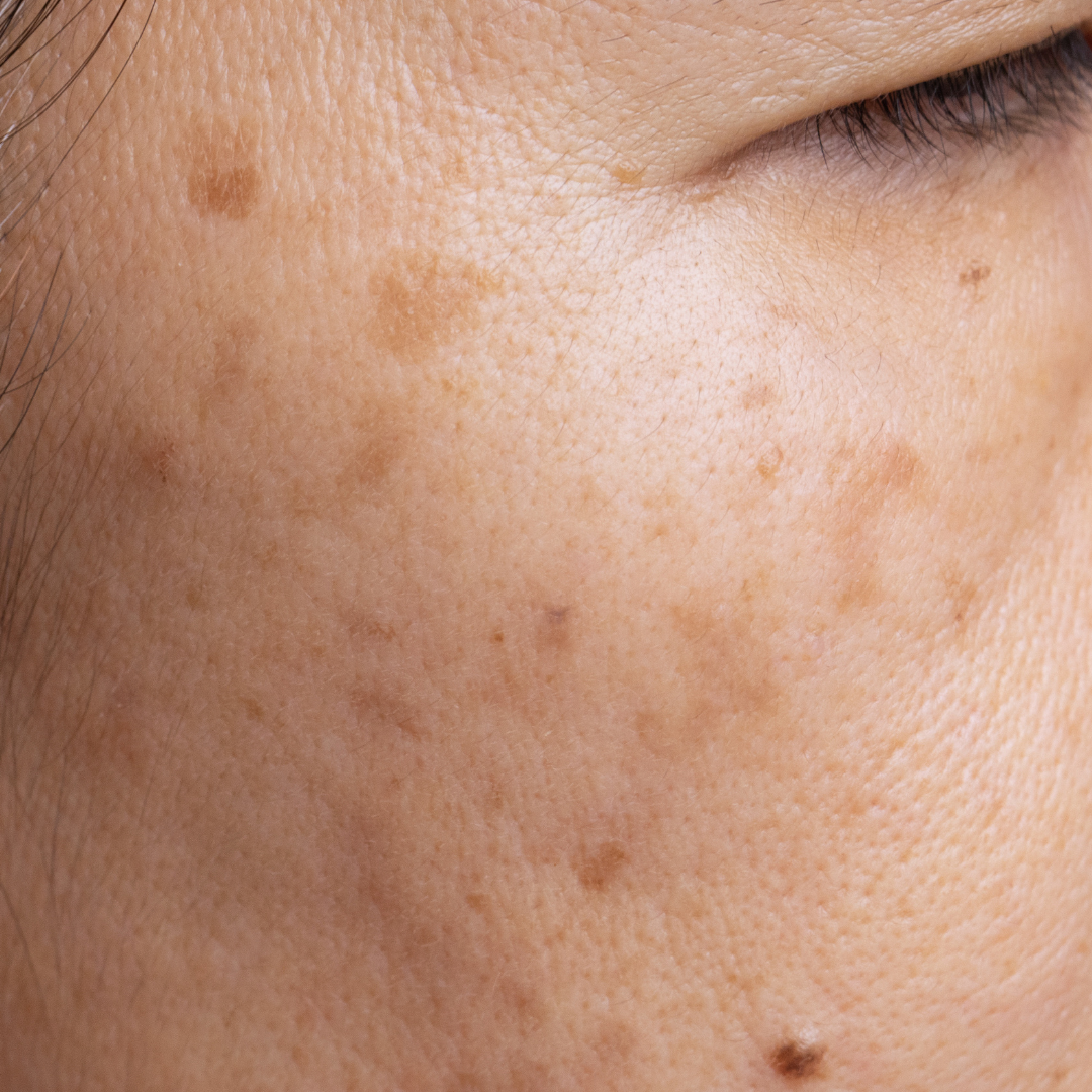 closeup of a face with hyperpigmentation dark spots